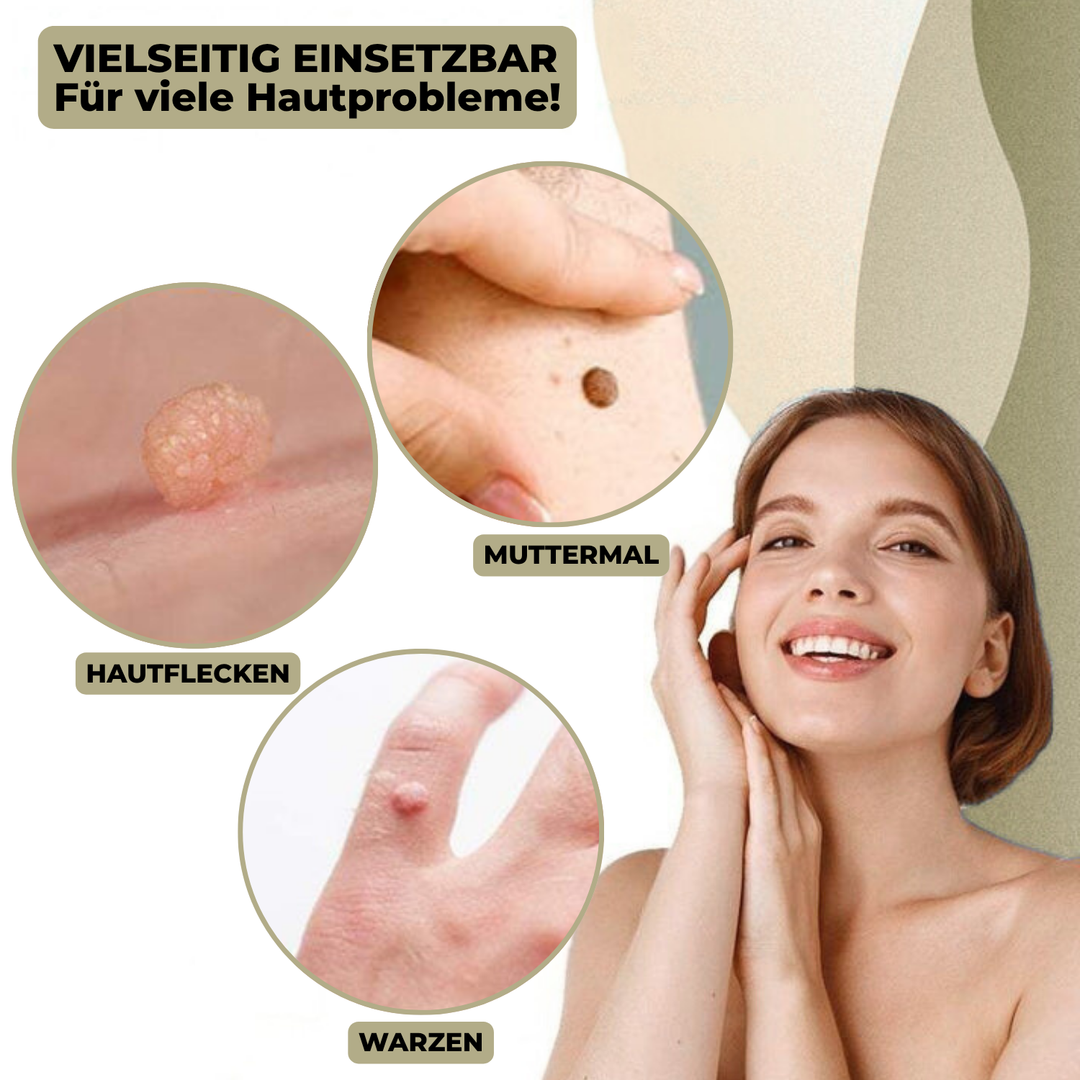 DermaLinx Vortefjerner | Smertefri fjerning av vorter og føflekker | Til hjemmebruk | Uten kirurgi