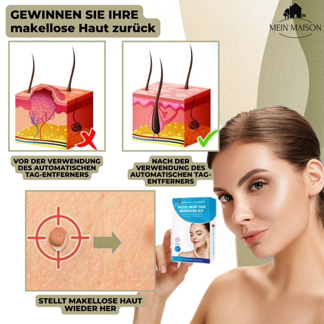 DermaLinx Vortefjerner | Smertefri fjerning av vorter og føflekker | Til hjemmebruk | Uten kirurgi