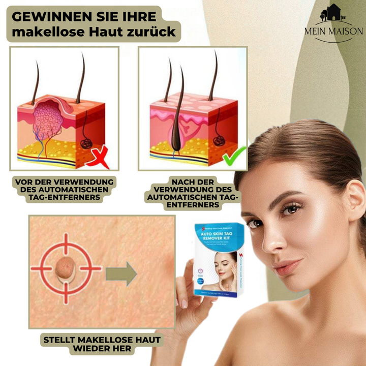 DermaLinx Vortefjerner | Smertefri fjerning av vorter og føflekker | Til hjemmebruk | Uten kirurgi
